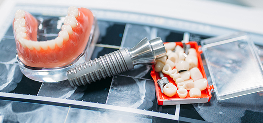 Keith Nelson Dentists Freemans Bay Auckland Removable and Fixed Dentures